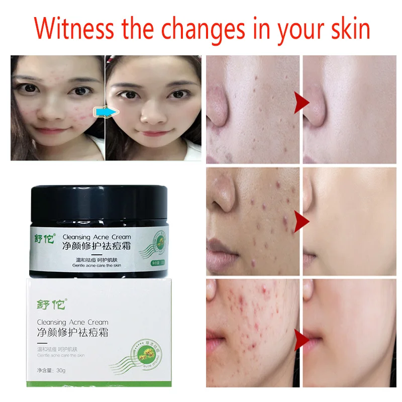 30g Repair Acne Cream Acne Hydrating To remove Scars Blackheads Shrink Pores Whitening Facial Skin Care Acne Cream
30g Repair Acne Cream Acne Hydrating To remove Scars Blackheads Shrink Pores Whitening Facial Skin Care Acne Cream