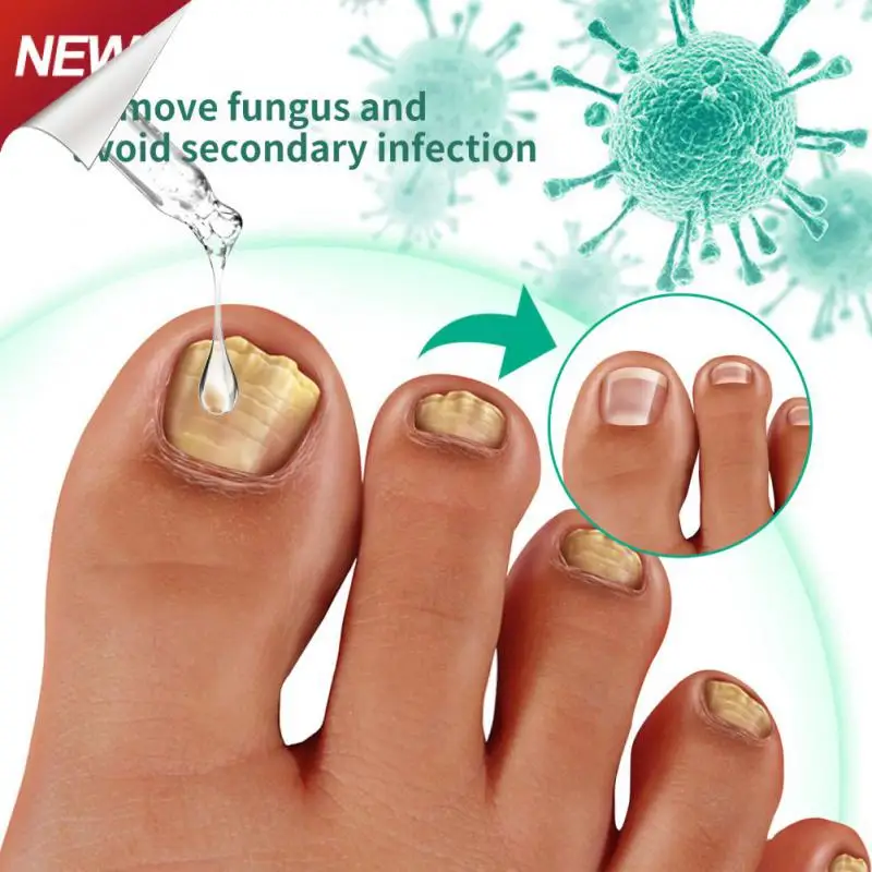 OUHOE Toenail Fungal Feet Care Nail Foot Whitening Toe Nail Repair Fungus Removal Gel Anti Paronychia Onychomycosis Feet Cares
OUHOE Toenail Fungal Feet Care Nail Foot Whitening Toe Nail Repair Fungus Removal Gel Anti Paronychia Onychomycosis Feet Cares