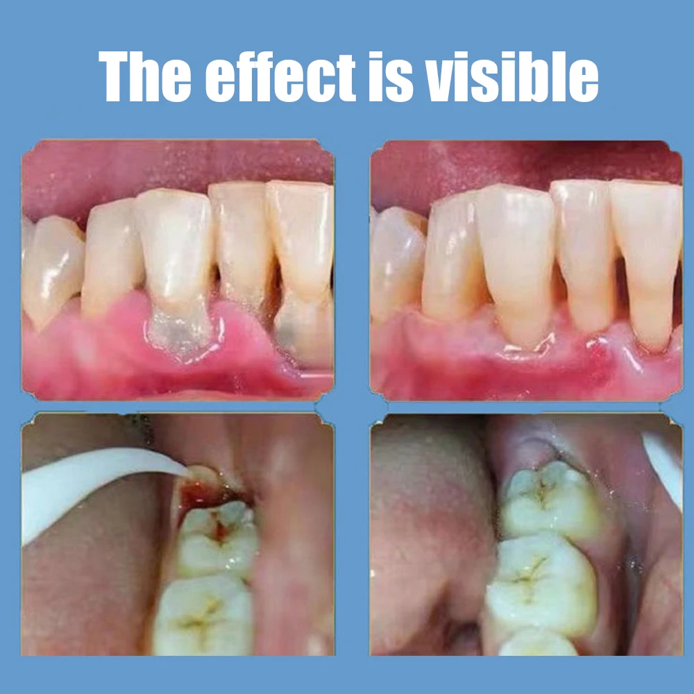 Quick Repair of Cavities Caries Removal of Plaque Stains Decay Whitening Yellowing Repair Teeth Teeth Whitening 100g 2023 New
Quick Repair of Cavities Caries Removal of Plaque Stains Decay Whitening Yellowing Repair Teeth Teeth Whitening 100g 2023 New