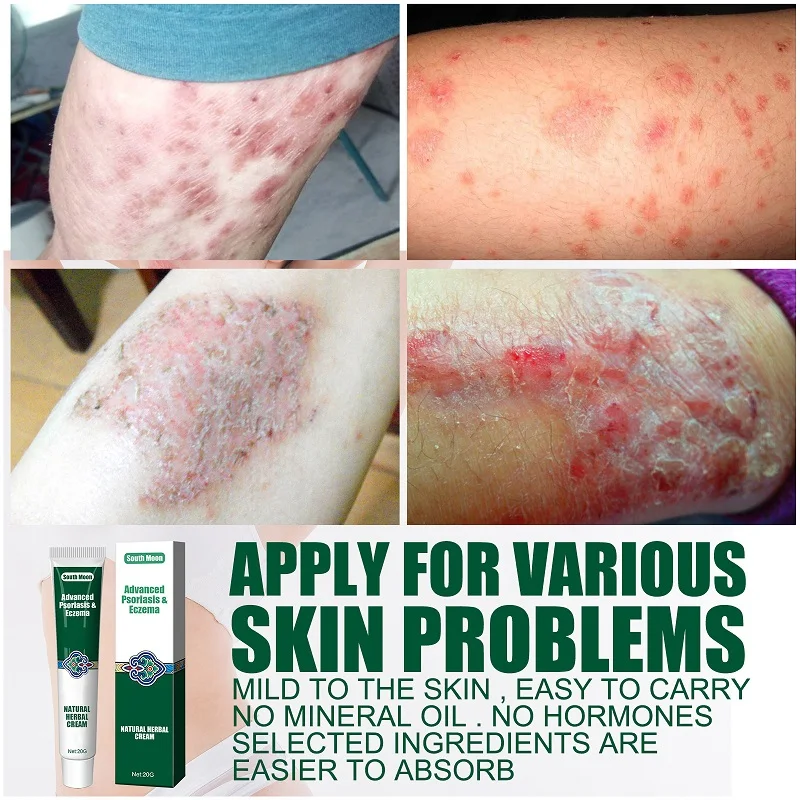 Herbal Eczema Ointment Antibacterial Cream Stop Psoriasis Dermatitis Gel Relieve Itching Irritation Allergy Repairing Skin Care
Herbal Eczema Ointment Antibacterial Cream Stop Psoriasis Dermatitis Gel Relieve Itching Irritation Allergy Repairing Skin Care