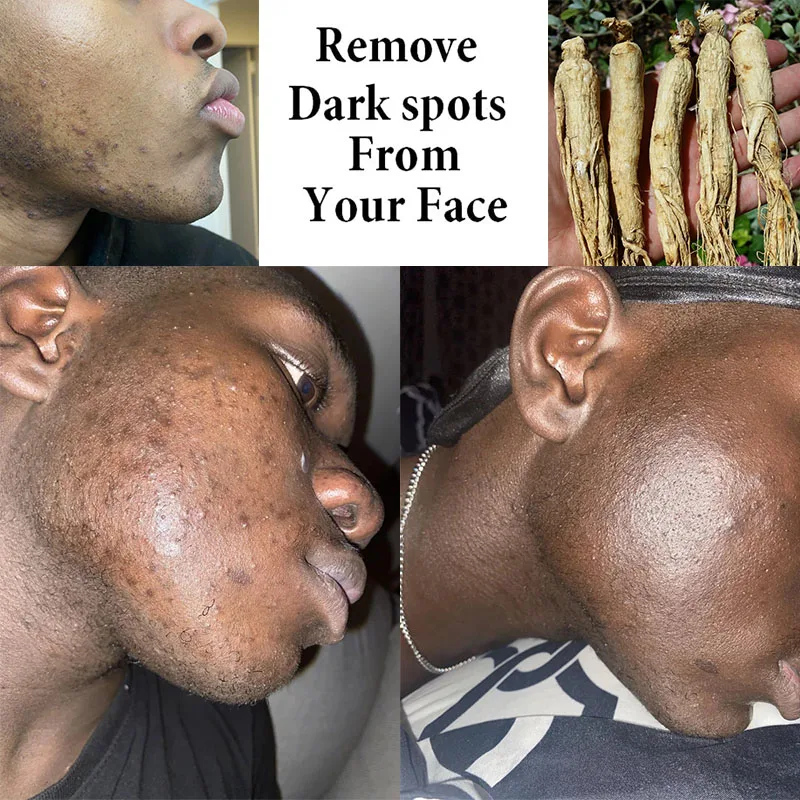 Facial Whitening Creams Solution for Dark Spots Niacinamide Secret To Remove Melanin Allantoin Exfoliator Even Tone Radiant Glow
Facial Whitening Creams Solution for Dark Spots Niacinamide Secret To Remove Melanin Allantoin Exfoliator Even Tone Radiant Glow