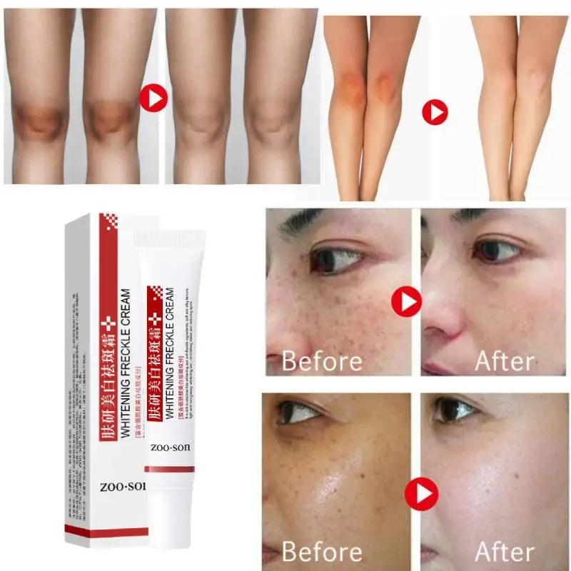 Freckle Cream Dark Spot Corrector Skin Whitening Fade Cream Lightening Blemish Removal Serum Reduces Age Spot Freckle Face Cream
Freckle Cream Dark Spot Corrector Skin Whitening Fade Cream Lightening Blemish Removal Serum Reduces Age Spot Freckle Face Cream