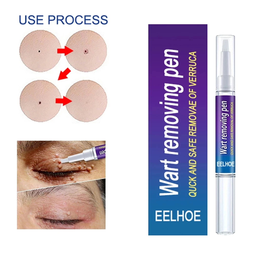 3ml Genital Wart Treatment Papillomas Removal Of Warts Liquid Removing Against Moles Remover Anti Verruca Remedy Dropshipping
3ml Genital Wart Treatment Papillomas Removal Of Warts Liquid Removing Against Moles Remover Anti Verruca Remedy Dropshipping