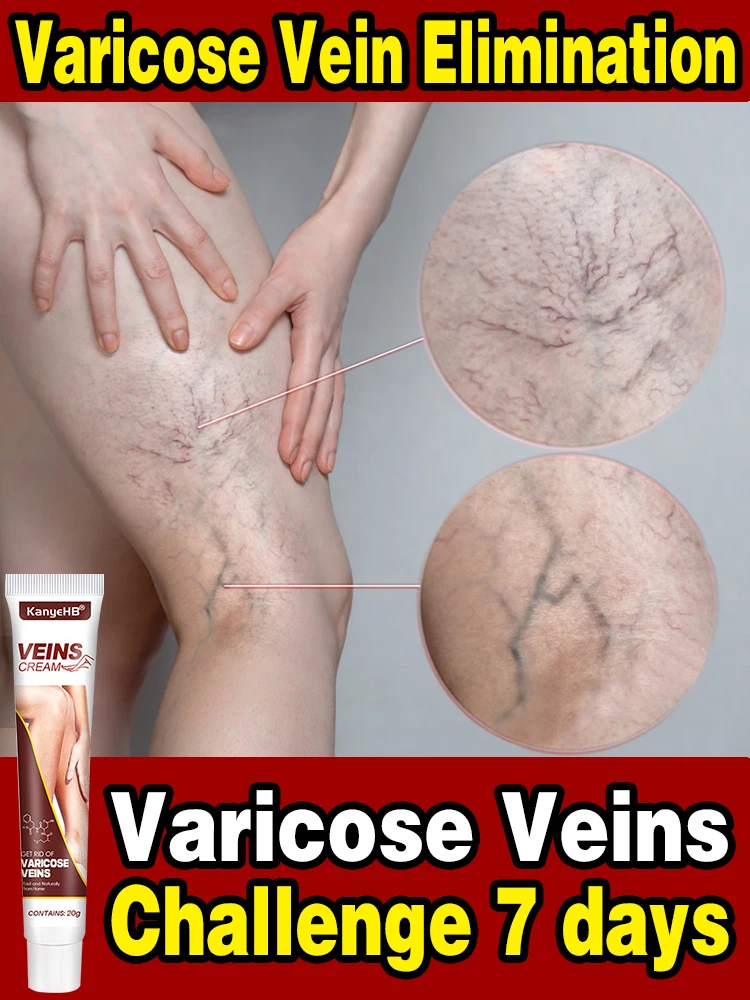 Effective varicose relief cream to eliminate spider leg Vasculitis phlebitis and relieve pain herbal ointmentl Ointment
Effective varicose relief cream to eliminate spider leg Vasculitis phlebitis and relieve pain herbal ointmentl Ointment