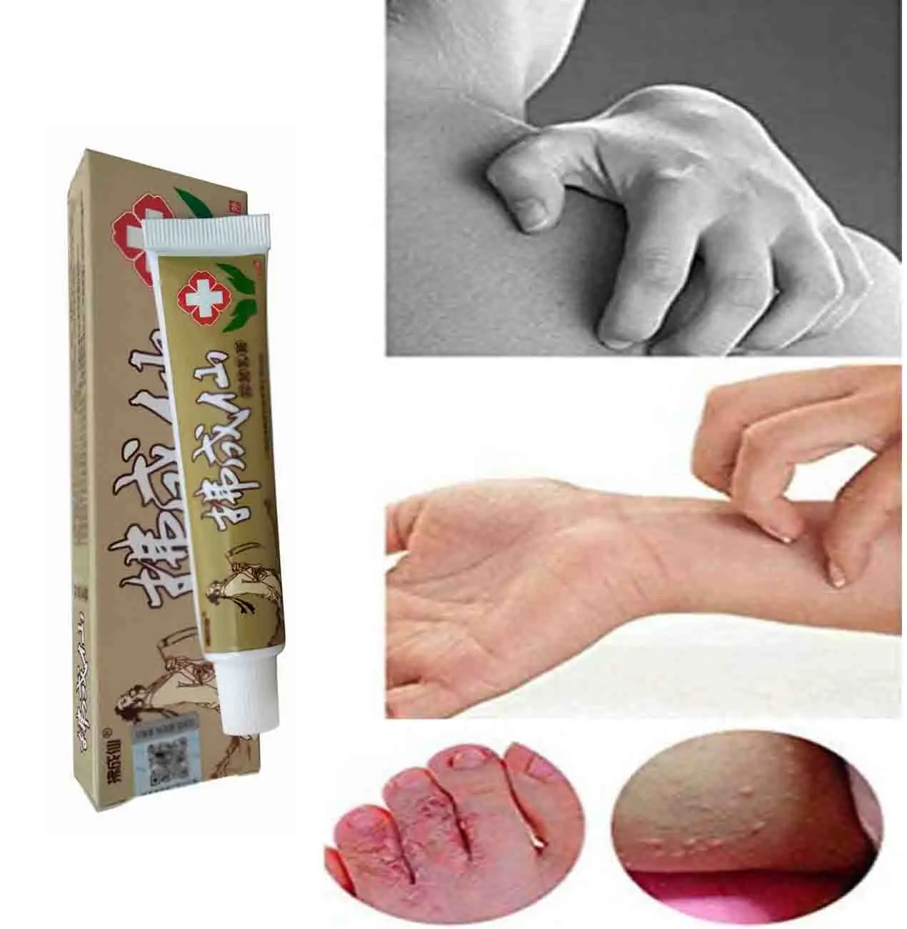 

Treatment Psoriasis Ointment Natural Chinese Herbal Eczema, Creams Dermatitis Pruritus Anti-Itch External Use FCX