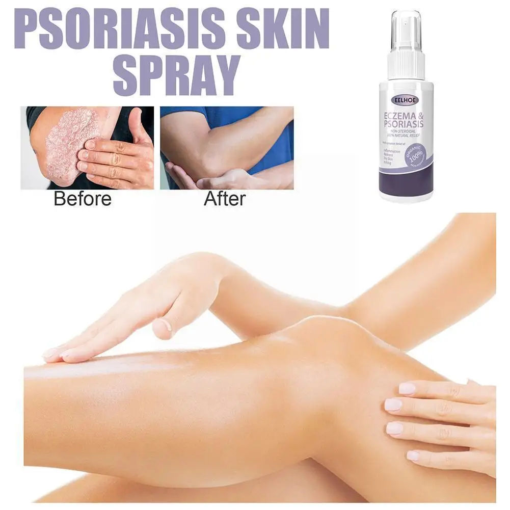 Herbal Eczema Psoriasis Spray Antibacterial Dermatitis Athletes Itching Irritation Foot Care Skin Allergies Relieve Lithosp G4q7
Herbal Eczema Psoriasis Spray Antibacterial Dermatitis Athletes Itching Irritation Foot Care Skin Allergies Relieve Lithosp G4q7