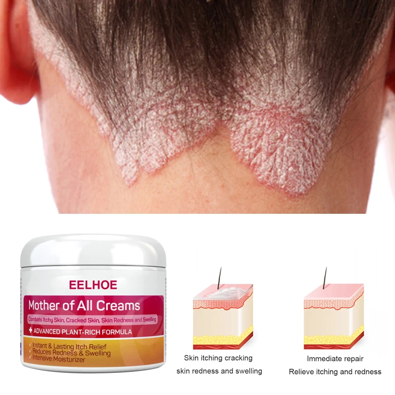 EELHOE Psoriasis Cream Eczema Ointment Psoriasis Treatments Hand Tinea Foot Odor Inhibit Dermatitis Fungus Anti-itch Cream Cares
EELHOE Psoriasis Cream Eczema Ointment Psoriasis Treatments Hand Tinea Foot Odor Inhibit Dermatitis Fungus Anti-itch Cream Cares
