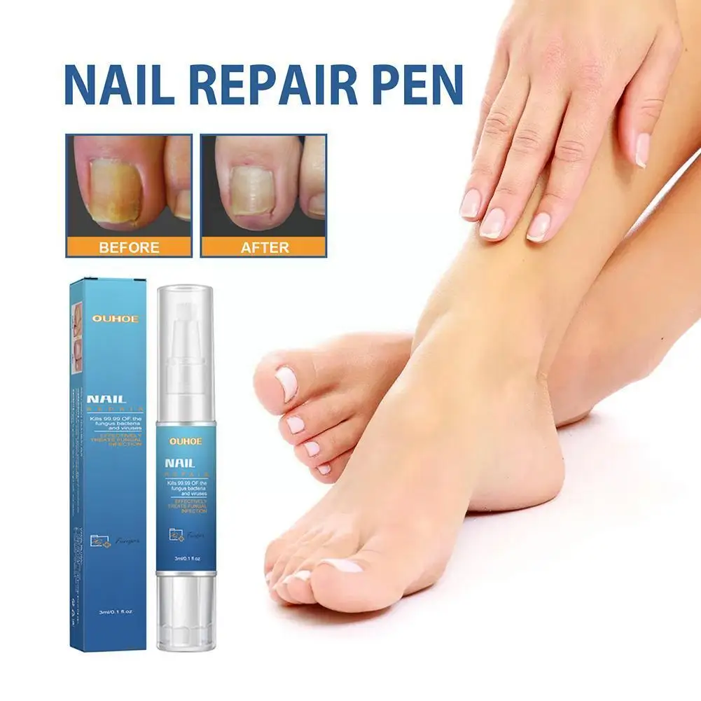 3ml Fungal Nail Treatments Pen Onychomycosis Paronychia Nail Fungus Anti Repair Toe Fungal Care Liquid U1t3
3ml Fungal Nail Treatments Pen Onychomycosis Paronychia Nail Fungus Anti Repair Toe Fungal Care Liquid U1t3