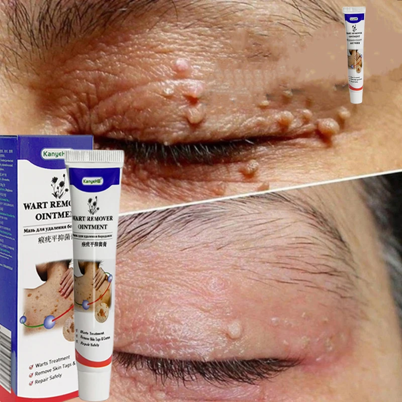 1Pcs Wart Removal Medical Cream Genital Warts Plantar Warts Ommon Warts Flat Wart Skin Tag Wart Remover Herbal Ointment
1Pcs Wart Removal Medical Cream Genital Warts Plantar Warts Ommon Warts Flat Wart Skin Tag Wart Remover Herbal Ointment