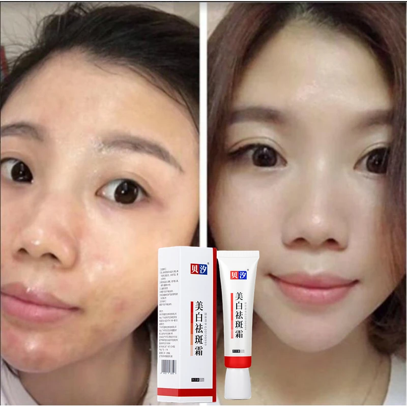 Whitening And Freckle Removing Cream To Remove Melasma, Fade Melanin And Brighten Melasma Removing Agent To Moisturize And Anti-
Whitening And Freckle Removing Cream To Remove Melasma, Fade Melanin And Brighten Melasma Removing Agent To Moisturize And Anti-
