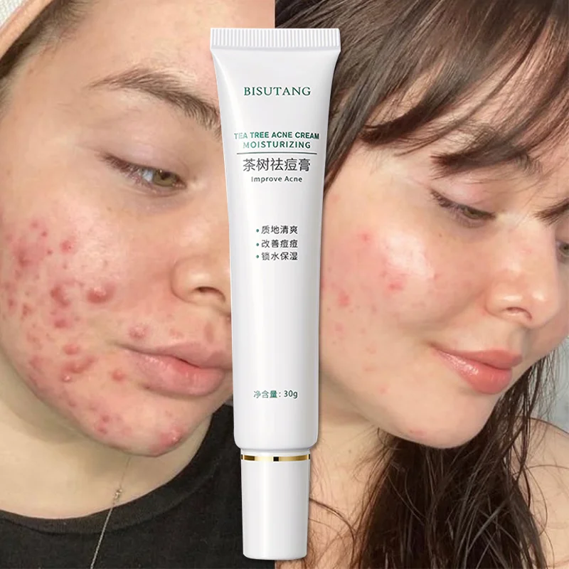 Эффективный крем для удаления акне, 30 г, контроль жирности, увлажнение, отбеливание, восстановление пятен, лечение акне, гель, крем для ухода ...
Эффективный крем для удаления акне, 30 г, контроль жирности, увлажнение, отбеливание, восстановление пятен, лечение акне, гель, крем для ухода ...