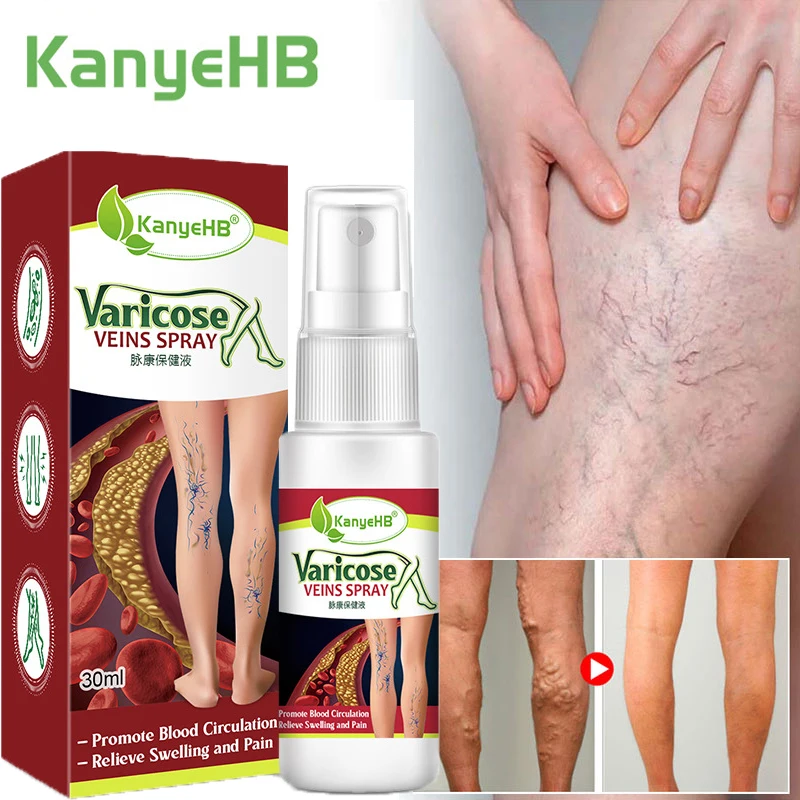 Herbal Varicose Veins Treatment Spray Vasculitis Phlebitis Spider Pain Relief Cream Relieve Legs Tired Dilated Medical Body Care
Herbal Varicose Veins Treatment Spray Vasculitis Phlebitis Spider Pain Relief Cream Relieve Legs Tired Dilated Medical Body Care