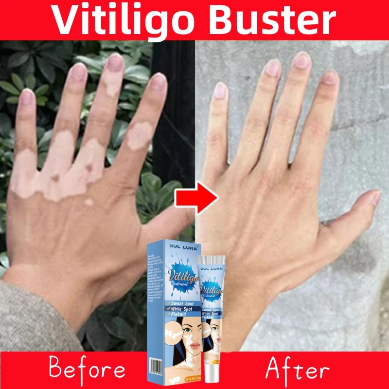 Herbal Extract Vitiligo Ointment Quick Removal Vitiligo Eliminate Skin Leukoplakia Disease Relief Skin Topical Treatment Cream
Herbal Extract Vitiligo Ointment Quick Removal Vitiligo Eliminate Skin Leukoplakia Disease Relief Skin Topical Treatment Cream