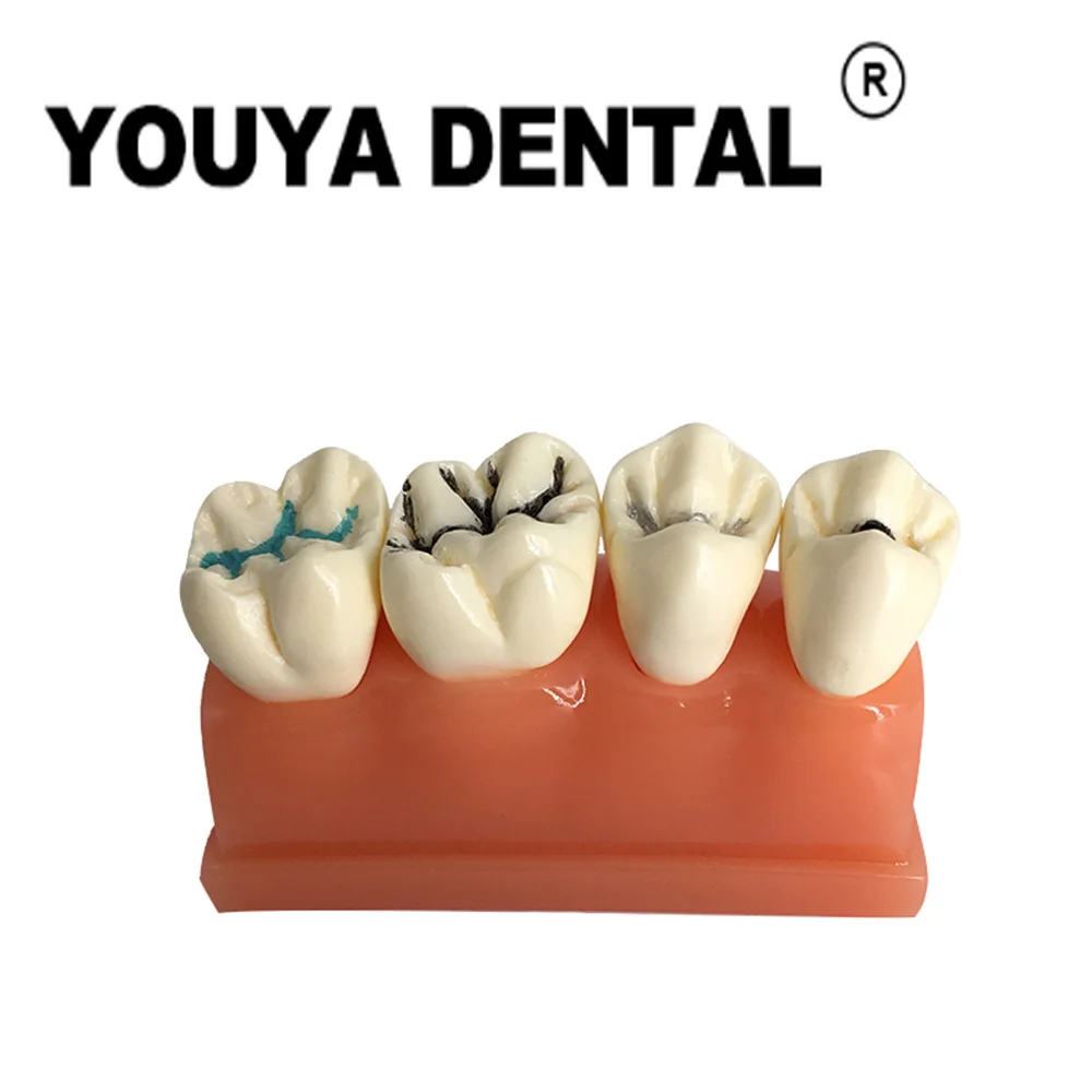 4 times Pit And Fissure Sealant Dental Model For Dental Student Studying Teaching Medical Science Oral Dentistry Products
4 times Pit And Fissure Sealant Dental Model For Dental Student Studying Teaching Medical Science Oral Dentistry Products