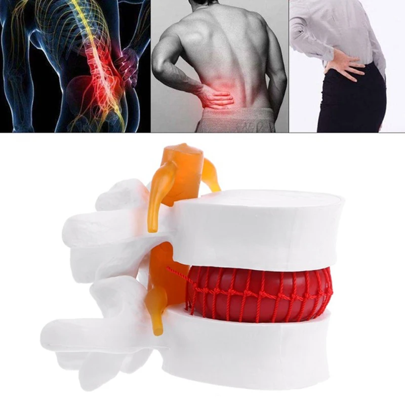 

Human Anatomical Spine Lumbar Disc Herniation Model Anatomy Instrume Medical Learning Aid Tool