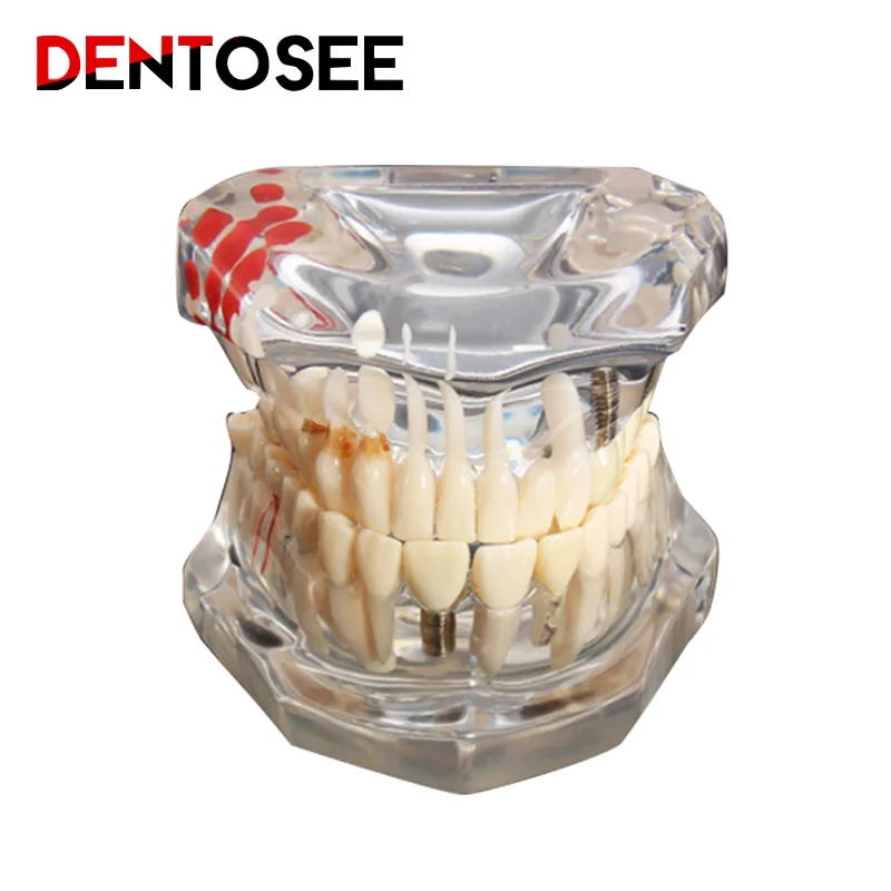 Implant Dental Disease Teeth Model With Restoration Bridge Tooth Dentist For Medical Science Dental Disease Teaching Study Tool
Implant Dental Disease Teeth Model With Restoration Bridge Tooth Dentist For Medical Science Dental Disease Teaching Study Tool