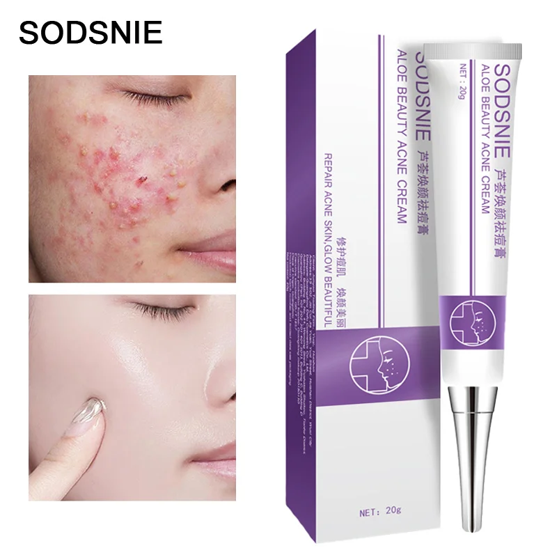 Acne Treatment Cream Remove Pimples Blackheads Antibacterial Fade Acne Marks Repair Skin Inflammation Whitening Skin Care 20g
Acne Treatment Cream Remove Pimples Blackheads Antibacterial Fade Acne Marks Repair Skin Inflammation Whitening Skin Care 20g