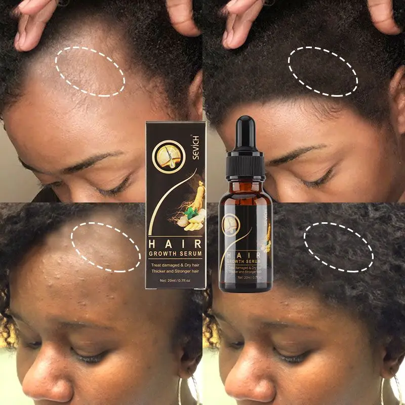 

20ml Hair Growth SEVICH Scalp Care Prevent Hair Loss Essence Treatment Oil Vitamin Ginger Repair Hair Dry Damaged Care Product