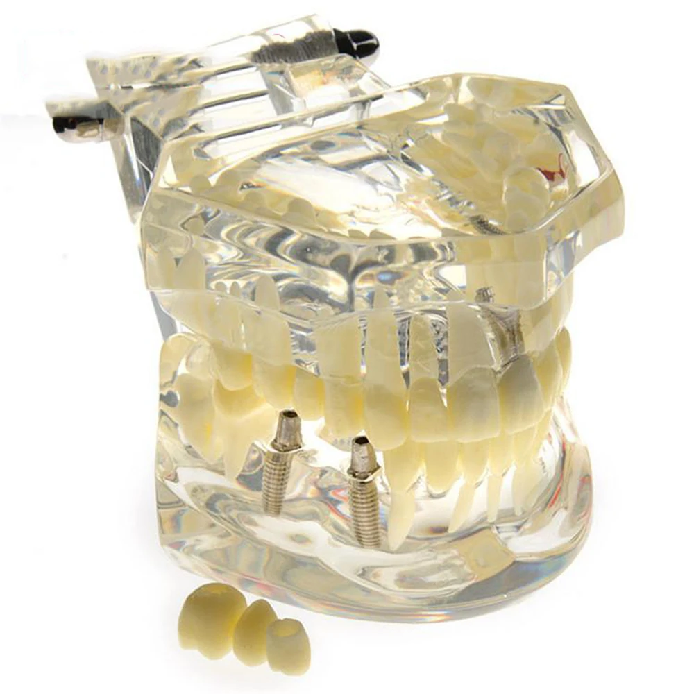 Dental Implant Disease Teeth Model with Restoration & Bridge Tooth Ideal for Treatment Planning Discussions with Patients
Dental Implant Disease Teeth Model with Restoration & Bridge Tooth Ideal for Treatment Planning Discussions with Patients