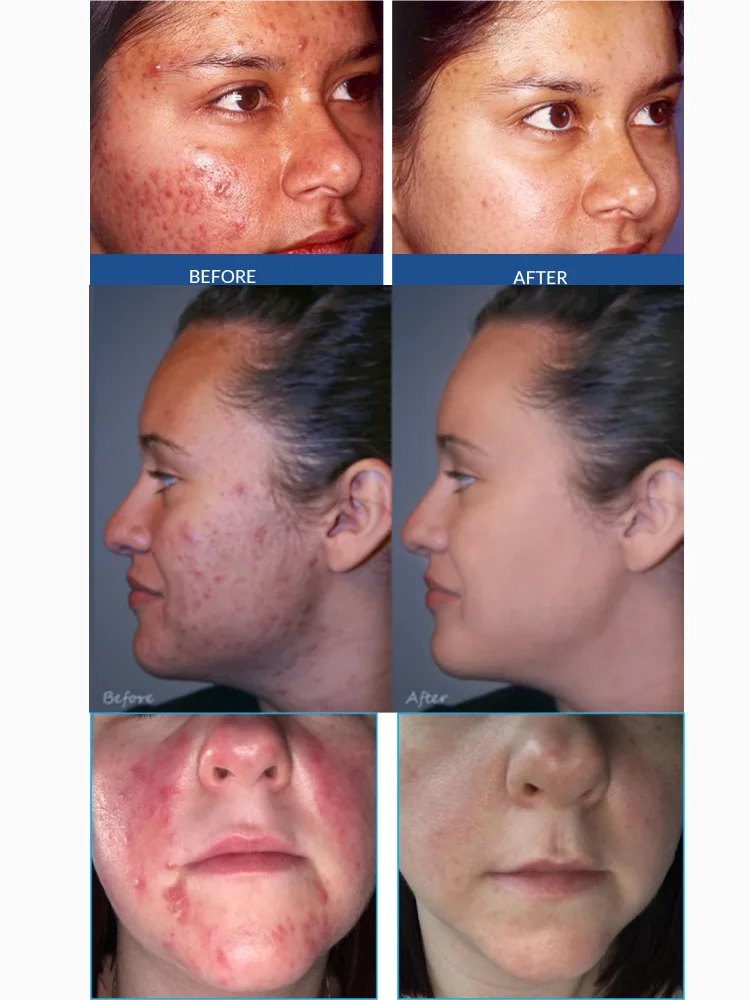 

B-Tox Peel For Antiance Acne Cream Face Care Serum Remove Acne Eliminate Mark Pore Contraction Oil Control Anti-Inflammatory