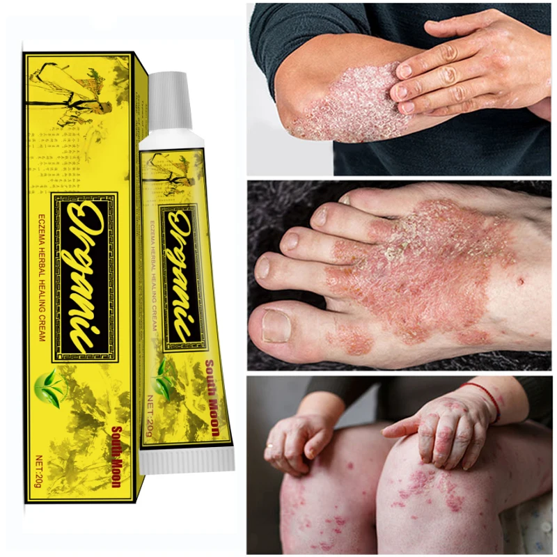 

Antibacterial Psoriasis Cream Effective Anti-itch Herbal Relief Dermatitis Eczema Treatment Urticaria Desquamation Care Ointment