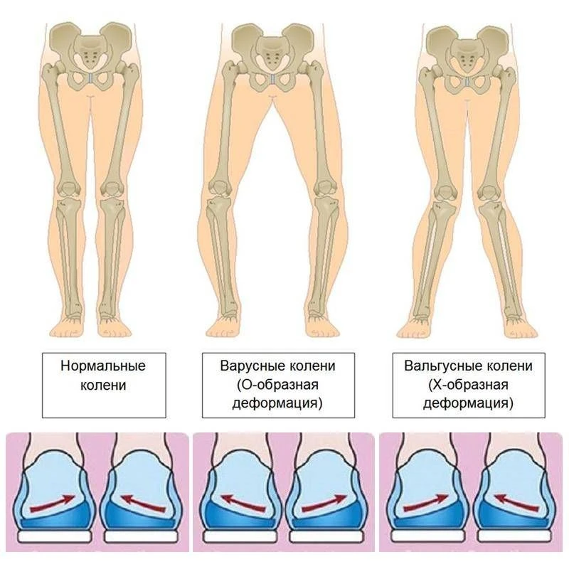 Кривизна ног и ее последствия