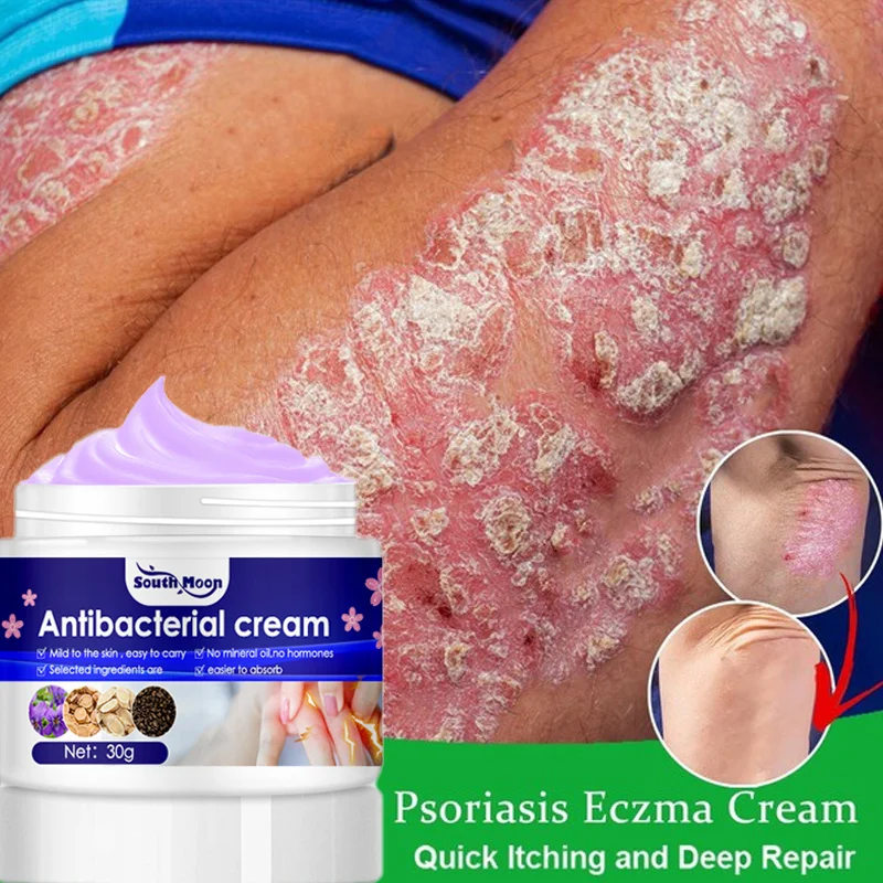 

Antibacterial Psoriasis Cream Herbal Effective Anti-itch Treatment Dermatitis Eczema Relief Urticaria Desquamation Ointment Gel