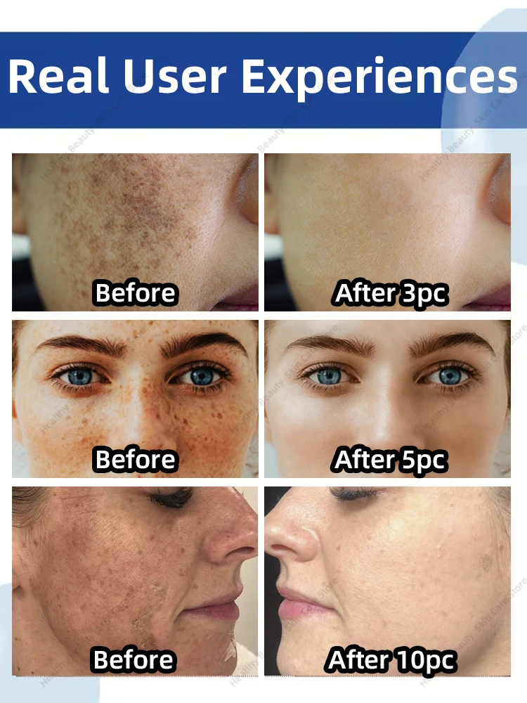 blemi-sh stain fre-ckles dark spo-ts m-elasma remover