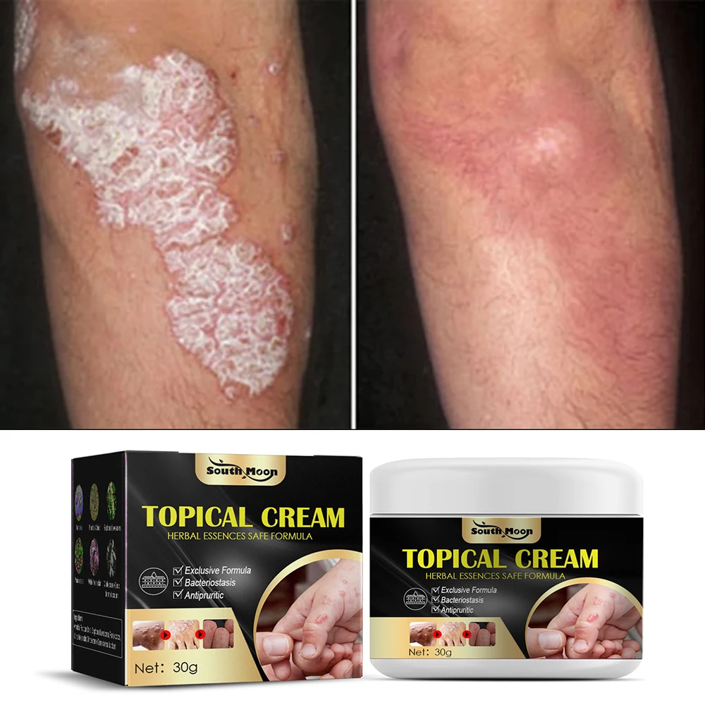 

Herb Psoriasis Cream Itching Antibacterial Eczema Dermatitis Urticaria Desquamate Relief Skin Dry Mosquito Bites Anti-Itch Cream