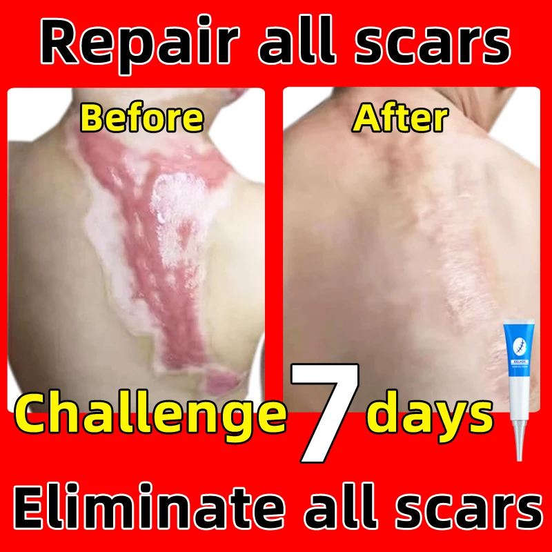 Scar cream gel effective repair surgical scars stretch marks acne pits pockmarks burn scars repair treatment