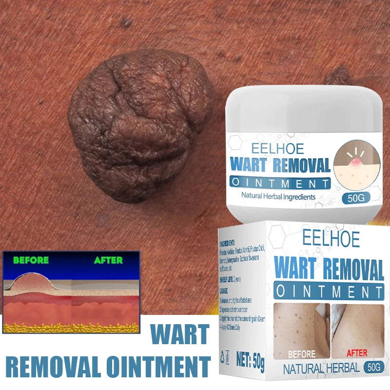 

Warts Removal Cream Safe Painless Skin Tags Body Warts Acne Treatment Neck Armpit Flat Warts Moles Remover Ointment Skin Care