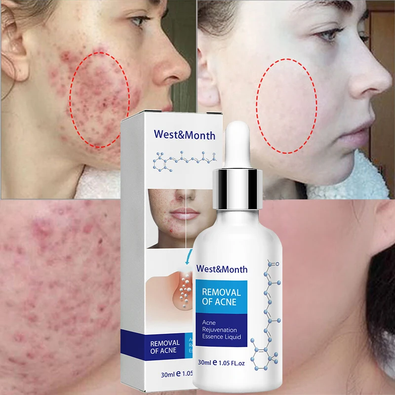 

Acne Treatment Face Serum Anti Acne Spots Removal Shrink Pores Oil Control Nicotinamide Whitening Moisturizing Repair Skin Care