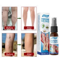 varicose veins relief spray vasculitis phlebitis spider legs smoothing ointment treatment blood swelling medical healthy care