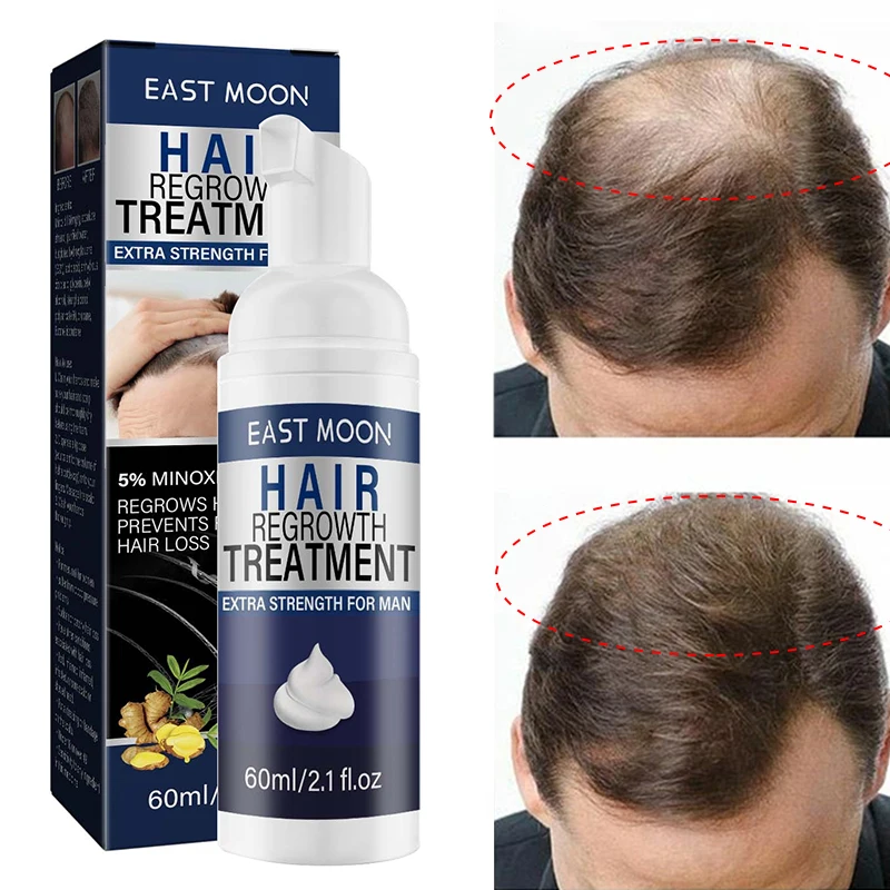 

Ginger Hair Growth Products Fast Growing Hair Mousse Anti Hair Loss Prevent Hair Dry Thinning Scalp Repair For Men Beauty Care