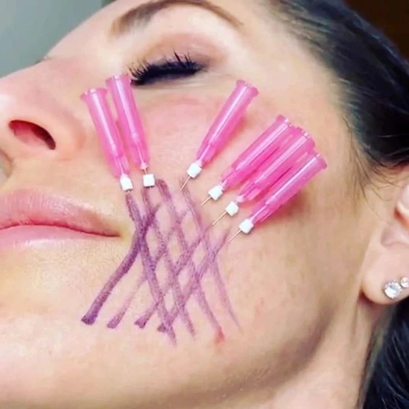 

PDO PCL PLLA Mono Screw CE Supplier Anti-wrinkles Mono Screw Thread Lifting For Face Neck And Body Pdo Thread Lift