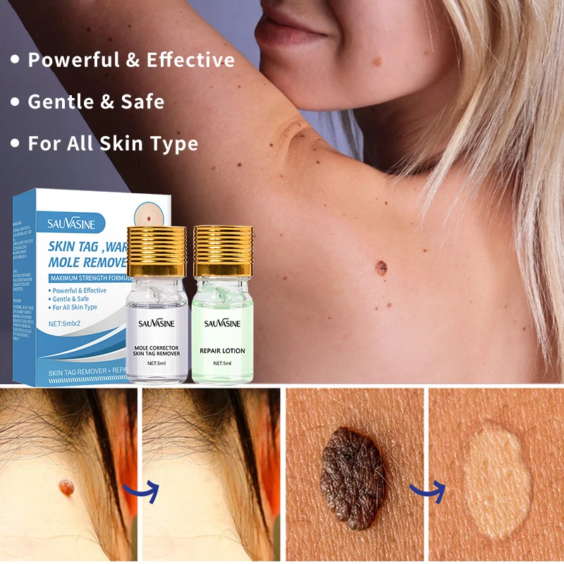 

Wart Sets Removing Against Moles Remover Anti Verruca Remedy Liquid Treatment Papillomas Removal Of Warts Liquid From Skin Tags