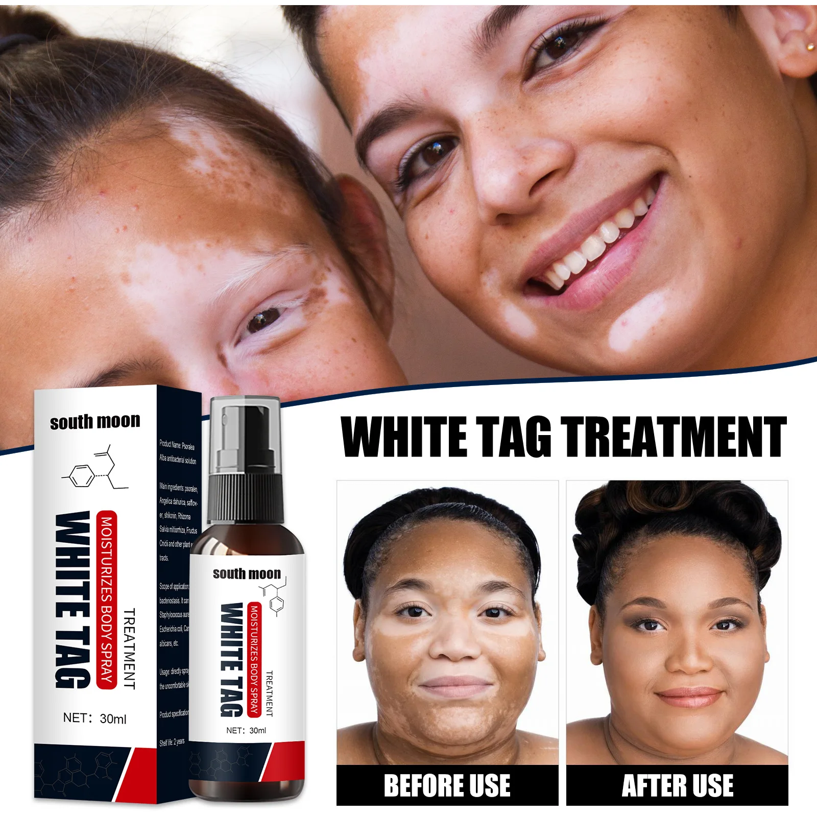 

White Spot Remover Spray Herbal Antibacterial Vitiligo Treatment Serum Leukoplakia Disease Pigment Melanin Repair Body Face Care