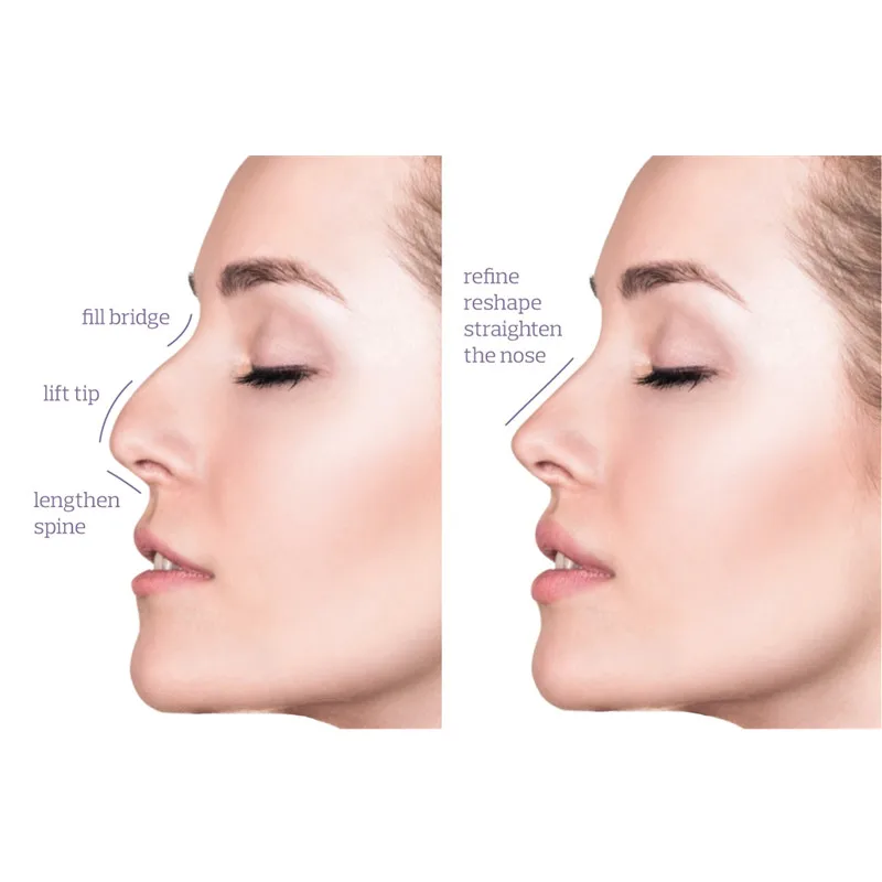 

Medical Skin 10PCS Hilos PDO PCL Nose Thread Lift Korea Beauty Product With L Blunt 19G Nasal Tip Treatment