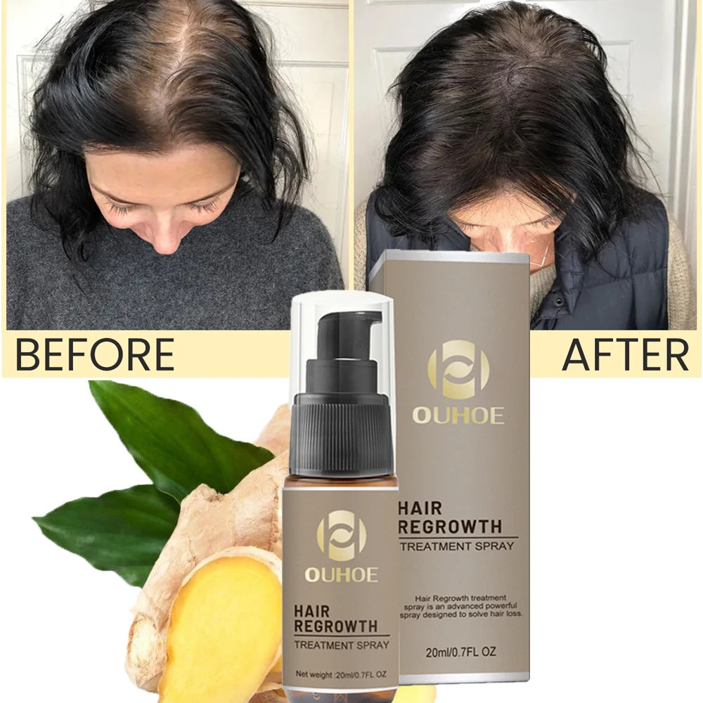 

Имбирное масло для роста волос, эффективное масло для роста волос, восстановление облысения, семейное выпадение волос, себоррейные волосы, против выпадения волос после родов