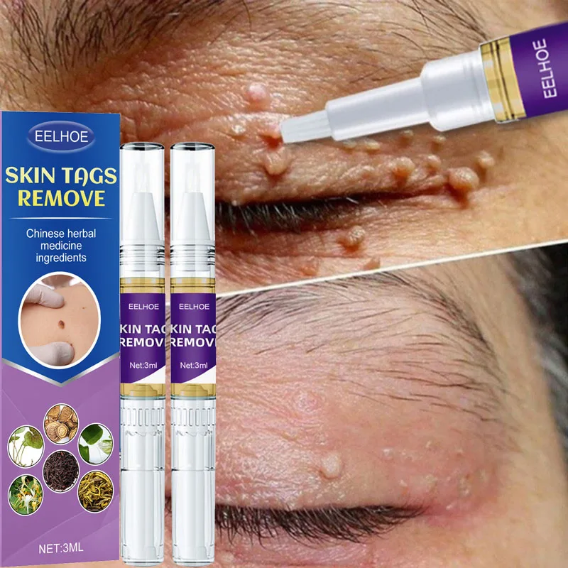 

Skin Tags Removal Liquid Pen Painless Mole Flat Wart Genitals Dark Spots Papillomas Remover Skin Labels Beauty Herbal Cream Care