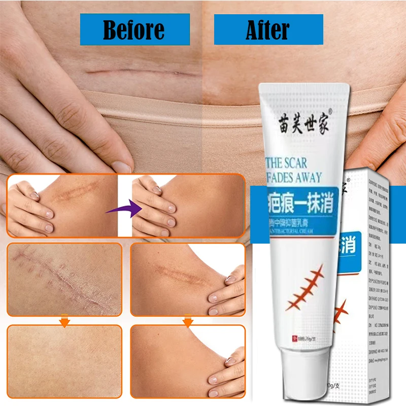 

Scar Removal Cream For Woman Man Old Scars Stretch Mark for Stretch Marks Relief Burns Repair Face Skin Repair Cream