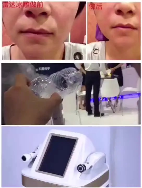 

Portable Radar line carve V-Max Cartridge ultrasound wrinkle removal face lift tightening machine