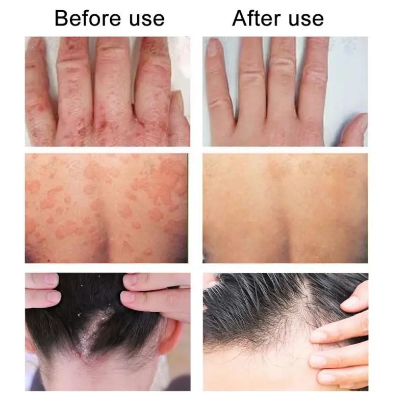 10/30/50 г экзема крем завод насыщенная формула быстро впитывается уменьшить