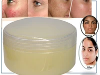 remove freckle speckle peels dark spot face facial skin whitening cream