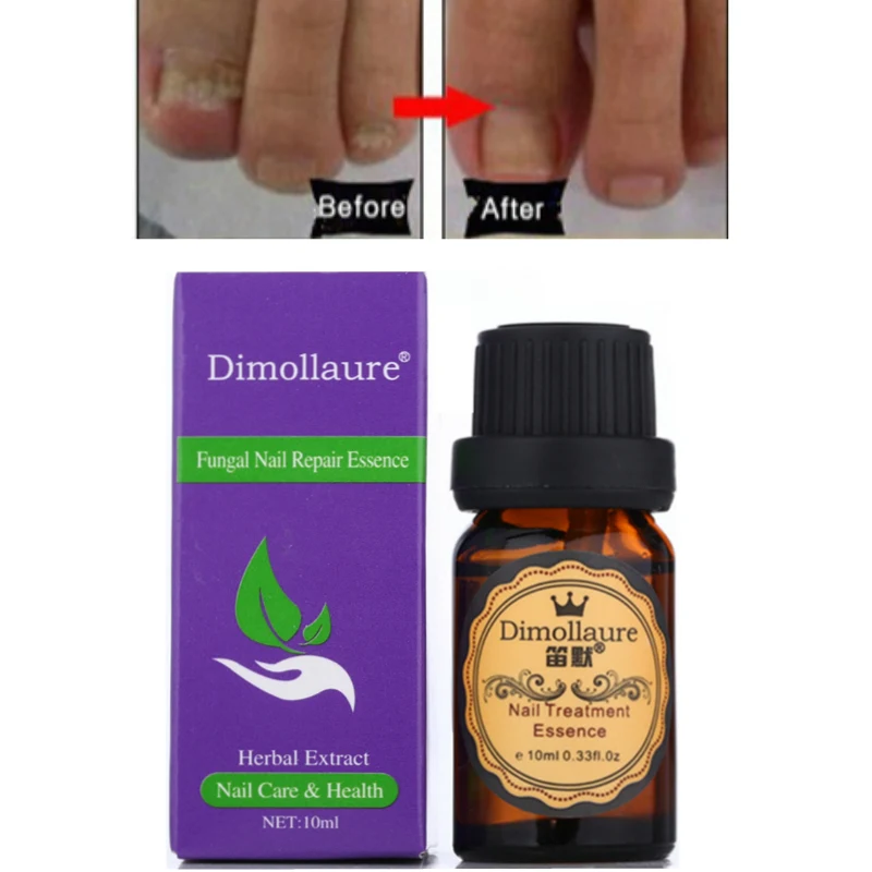 

Dimollaure Fungal Nail Treatment Essence Nail Foot Hand Care Toe Nail Anti Fungus Removal Infection Nail Gel Paronychia
