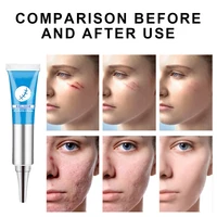 skincare scar removal cream acne scars gel stretch marks acne pigmentation scar repair surgical spots care for body burn correct