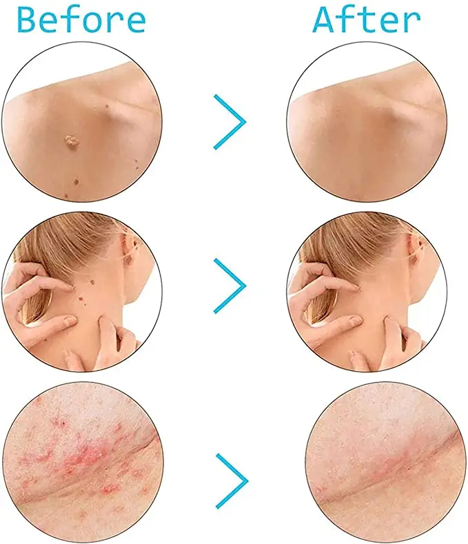 

144PCS Skin Tag Remover Patch Ance Pimple Patch Reatment Hydrocolloid Patch Protecting Skin Patch Skin Tag Acne Blemish Remover