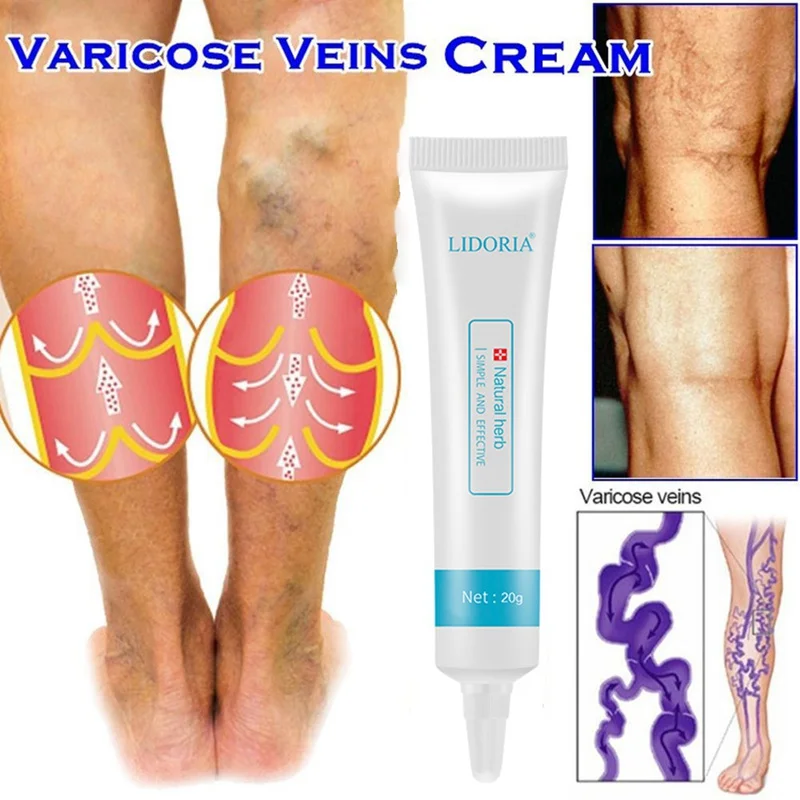 Varicose Veins Cream Promote Blood Circulation Relief Phlebitis Vasculitis Treatment Ointment Vessel Care |
