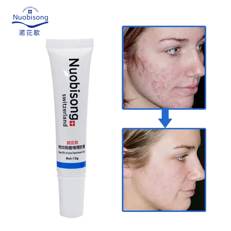 

Nuobisong/face skin care treatment the face Pimples scar Stretch Marks removal acne treatment whitening moisturizing cream