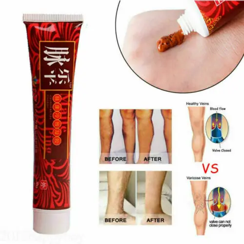 Крем для лечения варикозного расширения вен лечение Варикозного ангиит